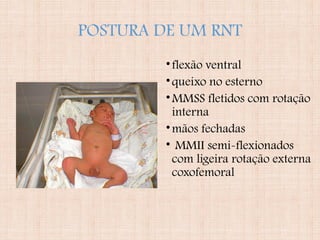 POSTURA DE UM RNT
•flexão ventral
•queixo no esterno
•MMSS fletidos com rotação
interna
•mãos fechadas
• MMII semi-flexionados
com ligeira rotação externa
coxofemoral
 