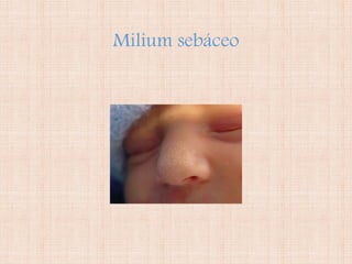 Milium sebáceo
 
