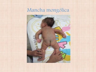 Mancha mongólica
 