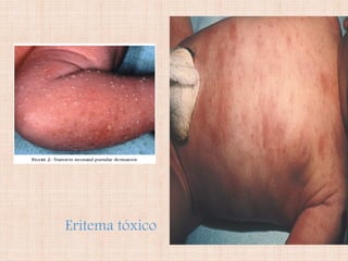 Eritema tóxico
 