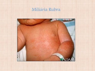 Miliária Rubra
 