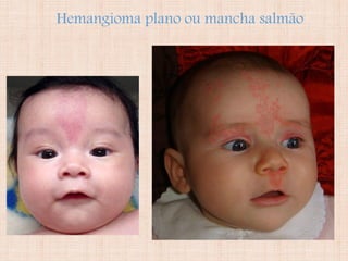 Hemangioma plano ou mancha salmão
 