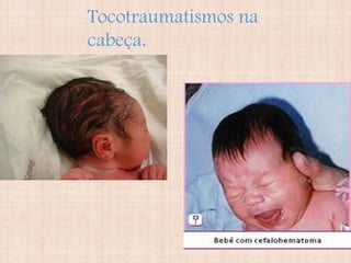 Tocotraumatismos na
cabeça.
 