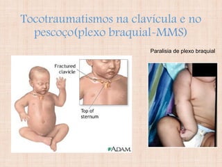 Tocotraumatismos na clavícula e no
pescoço(plexo braquial-MMS)
Paralisia de plexo braquial
 