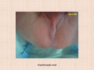 Imperfuração anal
 