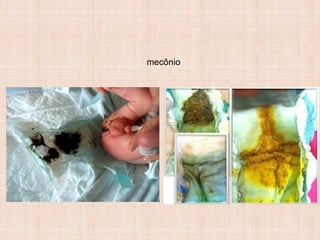 mecônio
 