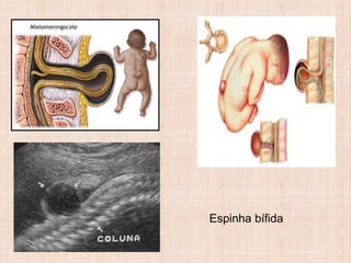 Espinha bífida
 