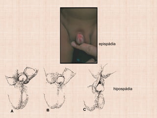 epispádia
hipospádia
 