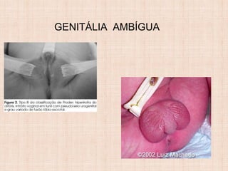 GENITÁLIA AMBÍGUA
 