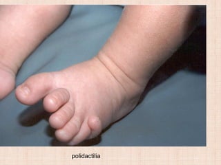 polidactilia
 