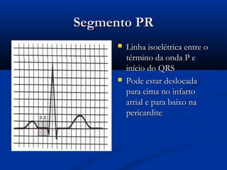 Segmento PRSegmento PR
 Linha isoelétrica entre oLinha isoelétrica entre o
término da onda P etérmino da onda P e
início do QRSinício do QRS
 Pode estar deslocadaPode estar deslocada
para cima no infartopara cima no infarto
atrial e para baixo naatrial e para baixo na
pericarditepericardite
 