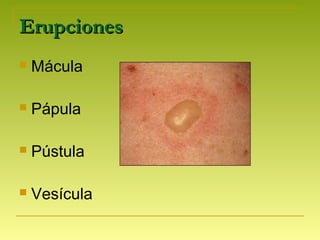 ErupcionesErupciones
 Mácula
 Pápula
 Pústula
 Vesícula
 