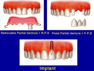 Rpcvs Rpi Dentures introduction to prosthodontics | PPT