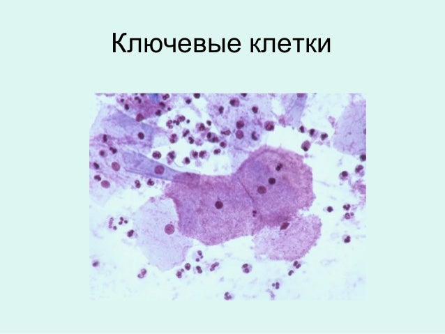 микрофлора ключевые клетки. гинекологический мазок микроскопия ключевые клетки. возбудитель бактериального вагиноза. бактериальный вагиноз цитология. микрофлора ключевые клетки.