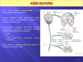  Ağrı lifleri lateral spinotalamik tr ile
anterolateral sisteme girerler
 Yukarı tırmanan lifler talamustaki özgül
duysal durak çekirdeklerine, buradan da
serebral kortekse gider
 Anterolateral sistemin lezyonları, lezyon
seviyesinin ALTINDA vücudun KARŞI
YARISINDA (KONTRLATERAL):
 AĞRI
 ISI
 KABA DOKUNMA duyularında eksikle
sonuçlanır
 Ağrı stimulusu singulat girus, SI, SIl gibi 3
kortikal alanı aktive eder
30
AĞRI DUYUSU
 