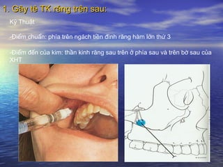 1. Gây tê TK răng trên sau:1. Gây tê TK răng trên sau:
Kỹ Thuật
-Điểm chuẩn: phía trên ngách tiền đình răng hàm lớn thứ 3
-Điểm đến của kim: thần kinh răng sau trên ở phía sau và trên bờ sau của
XHT
 