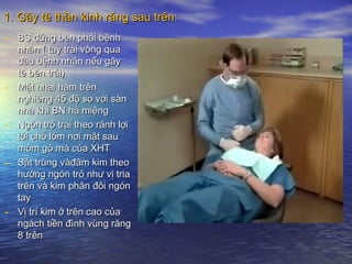 1. Gây tê thần kinh răng sau trên:1. Gây tê thần kinh răng sau trên:
- BS đứng bên phải bệnhBS đứng bên phải bệnh
nhân ( tay trái vòng quanhân ( tay trái vòng qua
đầu bệnh nhân nếu gâyđầu bệnh nhân nếu gây
tê bên trái)tê bên trái)
- Mặt nhai hàm trênMặt nhai hàm trên
nghiêng 45 độ so với sànnghiêng 45 độ so với sàn
nhà khi BN há miệngnhà khi BN há miệng
- Ngón trỏ trái theo rãnh lợiNgón trỏ trái theo rãnh lợi
tới chỗ lóm nơi mặt sautới chỗ lóm nơi mặt sau
mỏm gò má của XHTmỏm gò má của XHT
- Sát trùng vàđâm kim theoSát trùng vàđâm kim theo
hướng ngón trỏ như vị triahướng ngón trỏ như vị tria
trên và kim phân đôi ngóntrên và kim phân đôi ngón
taytay
- Vị trí kim ở trên cao củaVị trí kim ở trên cao của
ngách tiền đình vùng răngngách tiền đình vùng răng
8 trên8 trên
 