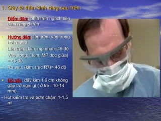 • Điểm đâmĐiểm đâm: phía trên ngách tiền: phía trên ngách tiền
đình răng 8 trênđình răng 8 trên
• Hướng đâmHướng đâm: lên trên- vào trong-: lên trên- vào trong-
hơi ra sauhơi ra sau
- Lên trên: (kim, mp nhai)=45 độLên trên: (kim, mp nhai)=45 độ
- Vào trong: ( kim, MP dọc giữa)Vào trong: ( kim, MP dọc giữa)
= 45 độ= 45 độ
- Ra sau: (kim, trục R7)= 45 độRa sau: (kim, trục R7)= 45 độ
• Độ sâuĐộ sâu: đẩy kim 1,6 cm không: đẩy kim 1,6 cm không
gặp trở ngại gì ( ở trẻ : 10-14gặp trở ngại gì ( ở trẻ : 10-14
mm)mm)
- Hút kiểm tra và bơm chậm 1-1,5- Hút kiểm tra và bơm chậm 1-1,5
mlml
1. Gây tê thần kinh răng sau trên:1. Gây tê thần kinh răng sau trên:
 