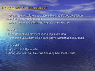 -- Chú ý: Nếu khi đẩy kim gặp điểm cản có thể do góc độ giữa kimChú ý: Nếu khi đẩy kim gặp điểm cản có thể do góc độ giữa kim
và mặt phẳng dọc giữa quá lớnvà mặt phẳng dọc giữa quá lớn
Kéo lùi nhẹ kim và đâm lại hướng mới chính xác hơnKéo lùi nhẹ kim và đâm lại hướng mới chính xác hơn
-ƯƯu điểm:u điểm:
+ ít đau do tiêm vào mô mềm không tiếp xúc xương+ ít đau do tiêm vào mô mềm không tiếp xúc xương
+ thành công 95%, giảm số lần đâm kim và lượng thuốc tê sử dụng+ thành công 95%, giảm số lần đâm kim và lượng thuốc tê sử dụng
-Nhược điểm:Nhược điểm:
+ nguy cơ thành lập tụ máu+ nguy cơ thành lập tụ máu
+ không kiểm soát đau hiệu quả trên răng hàm lớn thứ nhất+ không kiểm soát đau hiệu quả trên răng hàm lớn thứ nhất
1. Gây tê thần kinh răng sau trên:1. Gây tê thần kinh răng sau trên:
 