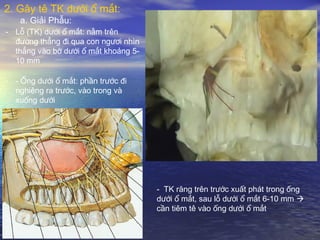 - Lỗ (TK) dưới ổ mắt: nằm trên
đường thẳng đi qua con ngươi nhìn
thẳng vào bờ dưới ổ mắt khoảng 5-
10 mm
- - Ống dưới ổ mắt: phần trước đi
nghiêng ra trước, vào trong và
xuống dưới
- TK răng trên trước xuất phát trong ống
dưới ổ mắt, sau lỗ dưới ổ mắt 6-10 mm 
cần tiêm tê vào ống dưới ổ mắt
2. Gây tê TK dưới ổ mắt:
a. Giải Phẫu:
 