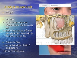 2. Gây tê TK dưới ổ mắt:2. Gây tê TK dưới ổ mắt:
- Vùng tê:Vùng tê:
- Chỉ ĐịnhChỉ Định
+ các can thiệp vùng răng+ các can thiệp vùng răng
cửa/nanh/hàm nhỏ trên cùngcửa/nanh/hàm nhỏ trên cùng
bênbên
+ Nhiễm trùng cấp tại chỗ ngăn+ Nhiễm trùng cấp tại chỗ ngăn
cản gây tê cận chóp hoặc docản gây tê cận chóp hoặc do
lớp xương vỏ quá dàylớp xương vỏ quá dày
- Chống chỉ định:Chống chỉ định:
+ chỉ can thiệp trên 1 hoặc 2+ chỉ can thiệp trên 1 hoặc 2
răng riêng rẽrăng riêng rẽ
+ BN có RL đông máu+ BN có RL đông máu
Mi dưới
mũi
Môi trên
 
