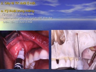 2. Gây tê TK dưới ổ mắt:2. Gây tê TK dưới ổ mắt:
a. Kỹ thuật trong miệnga. Kỹ thuật trong miệng
Kỹ thuật 1: đi từ vùng RHNKỹ thuật 1: đi từ vùng RHN
-Điểm chuẩn: phía cao ngách tiền đình R4Điểm chuẩn: phía cao ngách tiền đình R4
-Điểm đến: Lỗ dưới ổ mắtĐiểm đến: Lỗ dưới ổ mắt
 