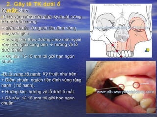 Kỹ thuật khác:Kỹ thuật khác:
-Đi từ vùng răng cửa giữaĐi từ vùng răng cửa giữa: kỹ thuật tương: kỹ thuật tương
tự như trên nhưngtự như trên nhưng
+ điểm chuẩn: ở ngách tiền đình vùng+ điểm chuẩn: ở ngách tiền đình vùng
răng cửa giữarăng cửa giữa
+ hướng kim: theo đường chéo mặt ngoài+ hướng kim: theo đường chéo mặt ngoài
răng cửa giữa cùng bênrăng cửa giữa cùng bên  hướng về lỗhướng về lỗ
dưới ổ mắtdưới ổ mắt
+ Độ sâu: 12-15 mm tới giới hạn ngón+ Độ sâu: 12-15 mm tới giới hạn ngón
chuẩnchuẩn
-Đi từ vùng hố nanhĐi từ vùng hố nanh: Kỹ thuật như trên: Kỹ thuật như trên
+ Điểm chuẩn: ngách tiền đình vùng răng+ Điểm chuẩn: ngách tiền đình vùng răng
nanh ( hố nanh),nanh ( hố nanh),
+ Hướng kim: hướng về lỗ dưới ổ mắt+ Hướng kim: hướng về lỗ dưới ổ mắt
+ Độ sâu: 12-15 mm tới giới hạn ngón+ Độ sâu: 12-15 mm tới giới hạn ngón
chuẩnchuẩn
2. Gây tê TK dưới ổ
mắt:
 