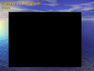 2. Gây tê TK dưới ổ mắt:2. Gây tê TK dưới ổ mắt:
VideoVideo
 