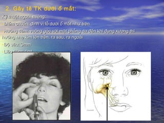 Kỹ thuật ngoài miệng:Kỹ thuật ngoài miệng:
-Điểm chuẩn: định vị lỗ dưới ổ mắt như trênĐiểm chuẩn: định vị lỗ dưới ổ mắt như trên
-Hướng tiêm: vuông góc với mặt phẳng da đến khi đụng xương thìHướng tiêm: vuông góc với mặt phẳng da đến khi đụng xương thì
hướng nhẹ kim lên trên, ra sau, ra ngoàihướng nhẹ kim lên trên, ra sau, ra ngoài
-Độ sâu: 3mmĐộ sâu: 3mm
-Liều tiêm: 1mLLiều tiêm: 1mL
2. Gây tê TK dưới ổ mắt:
 