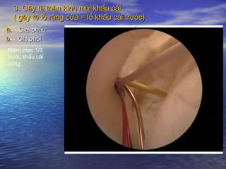 3. Gây tê thần kinh mũi khẩu cái3. Gây tê thần kinh mũi khẩu cái
( gây tê lỗ răng cửa = lỗ khẩu cái trước)( gây tê lỗ răng cửa = lỗ khẩu cái trước)
a.a. Giải phẫu:Giải phẫu:
b.b. Chi phốiChi phối
Niêm mạc 1/3
trước khẩu cái
cứng
 