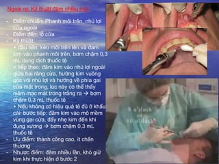 Ngoài ra: Kỹ thuật đâm nhiều mũi
- Điểm chuẩn: Phanh môi trên, nhú lợi
cửa ngoài
- Điểm đến: lỗ cửa
- Kỹ thuật:
+ đầu tiên: kéo môi trên lên và đam
kim vào phanh môi trên, bơm chậm 0,3
mL dung dịch thuốc tê
+ tiếp theo: đâm kim vào nhú lợi ngoài
giữa hai răng cửa, hướng kim vuông
góc với nhú lợi và hướng về phía gai
cửa mặt trong, lúc này có thể thấy
niêm mạc mặt trong trắng ra  bơm
chậm 0,3 mL thuốc tê
+ Nếu không có hiệu quả tê đủ ở khẩu
cái: bước tiếp: đâm kim vào mô mềm
vùng gai cửa, đẩy nhẹ kim đến khi
đụng xương  bơm chậm 0,3 mL
thuốc tê
- Ưu điểm: thành công cao, ít chấn
thương
- Nhược điểm: đâm nhiều lần, khó giữ
kim khi thực hiện ở bước 2
 