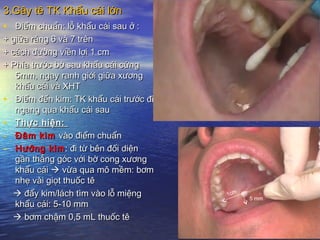 3.Gây tê TK Khẩu cái lớn3.Gây tê TK Khẩu cái lớn
• Điểm chuẩn: lỗ khẩu cái sau ở :Điểm chuẩn: lỗ khẩu cái sau ở :
+ giữa răng 6 và 7 trên+ giữa răng 6 và 7 trên
+ cách đường viền lợi 1 cm+ cách đường viền lợi 1 cm
+ Phía trước bờ sau khẩu cái cứng+ Phía trước bờ sau khẩu cái cứng
5mm, ngay ranh giới giữa xương5mm, ngay ranh giới giữa xương
khẩu cái và XHTkhẩu cái và XHT
• Điểm đến kim: TK khẩu cái trước điĐiểm đến kim: TK khẩu cái trước đi
ngang qua khẩu cái saungang qua khẩu cái sau
• Thực hiện:Thực hiện:
- Đâm kimĐâm kim vào điểm chuẩnvào điểm chuẩn
- Hướng kimHướng kim: đi từ bên đối diện: đi từ bên đối diện
gần thẳng góc với bờ cong xươnggần thẳng góc với bờ cong xương
khẩu cáikhẩu cái  vừa qua mô mềm: bơmvừa qua mô mềm: bơm
nhẹ vài giọt thuốc tênhẹ vài giọt thuốc tê
 đẩy kim/lách tìm vào lỗ miệngđẩy kim/lách tìm vào lỗ miệng
khẩu cái: 5-10 mmkhẩu cái: 5-10 mm
 bơm chậm 0,5 mL thuốc têbơm chậm 0,5 mL thuốc tê
1cm
5 mm
 