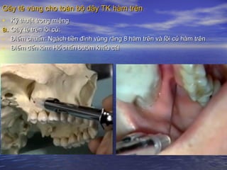 Gây tê vùng cho toàn bộ dậy TK hàm trênGây tê vùng cho toàn bộ dậy TK hàm trên
• Kỹ thuật trong miệngKỹ thuật trong miệng
a.a. Gây tê trên lồi củ:Gây tê trên lồi củ:
- Điểm chuẩn: Ngách tiền đình vùng răng 8 hàm trên và lồi củ hàm trênĐiểm chuẩn: Ngách tiền đình vùng răng 8 hàm trên và lồi củ hàm trên
- Điểm đến kim: Hố chấn bướm khẩu cáiĐiểm đến kim: Hố chấn bướm khẩu cái
 