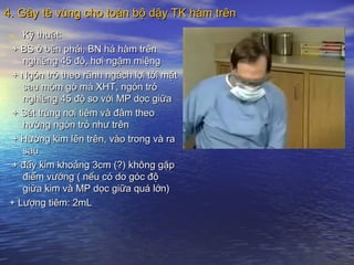 4. Gây tê vùng cho toàn bộ dậy TK hàm trên4. Gây tê vùng cho toàn bộ dậy TK hàm trên
- Kỹ thuật:Kỹ thuật:
+ BS ở bên phải, BN há hàm trên+ BS ở bên phải, BN há hàm trên
nghiêng 45 độ, hơi ngậm miệngnghiêng 45 độ, hơi ngậm miệng
+ Ngón trỏ theo rãnh ngách lợi tới mặt+ Ngón trỏ theo rãnh ngách lợi tới mặt
sau mỏm gò má XHT, ngón trỏsau mỏm gò má XHT, ngón trỏ
nghiêng 45 độ so với MP dọc giữanghiêng 45 độ so với MP dọc giữa
+ Sát trùng nơi tiêm và đâm theo+ Sát trùng nơi tiêm và đâm theo
hướng ngón trỏ như trênhướng ngón trỏ như trên
+ Hướng kim lên trên, vào trong và ra+ Hướng kim lên trên, vào trong và ra
sausau
+ đẩy kim khoảng 3cm (?) không gặp+ đẩy kim khoảng 3cm (?) không gặp
điểm vướng ( nếu có do góc độđiểm vướng ( nếu có do góc độ
giữa kim và MP dọc giữa quá lớn)giữa kim và MP dọc giữa quá lớn)
+ Lượng tiêm: 2mL+ Lượng tiêm: 2mL
 
