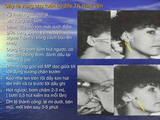 Gây tê vùng cho toàn bộ dậy TK hàm trênGây tê vùng cho toàn bộ dậy TK hàm trên
• Kỹ thuật ngoài miệngKỹ thuật ngoài miệng
- Sát trùng chỗ tiêmSát trùng chỗ tiêm
- Đánh dấu chỗ lõm mặt dưới điểmĐánh dấu chỗ lõm mặt dưới điểm
giữa cung gò má trên khuyếtgiữa cung gò má trên khuyết
sigma ( định vị bằng cách bảo Bnsigma ( định vị bằng cách bảo Bn
nhai)nhai)
- Dùng ống bơm tiêm hút ngược, cóDùng ống bơm tiêm hút ngược, có
kim dài chừng 8cm, đánh dấu tạikim dài chừng 8cm, đánh dấu tại
điểm 4,5 cmđiểm 4,5 cm
- Đâm thẳng góc với MP dọc giữa tớiĐâm thẳng góc với MP dọc giữa tới
khi đụng xương chân bướmkhi đụng xương chân bướm
- Kéo nhẹ len trên rồi đẩy kim hơiKéo nhẹ len trên rồi đẩy kim hơi
lên trên và ra trước tới dấu ghilên trên và ra trước tới dấu ghi
- Hút ngược, bơm chậm 2-3 mLHút ngược, bơm chậm 2-3 mL
( bơm 0,5 hút kiểm tra mỗi lần)( bơm 0,5 hút kiểm tra mỗi lần)
- DH tê thành công: tê mi dưới, bênDH tê thành công: tê mi dưới, bên
mũi, môi trên sau 3-5 phútmũi, môi trên sau 3-5 phút
 