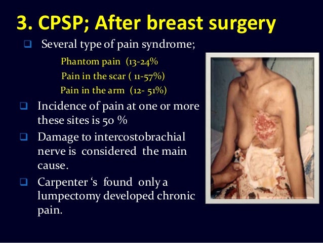 Chronic Pain After Surgery Chronic Post Surgical Pain Cpsp How To