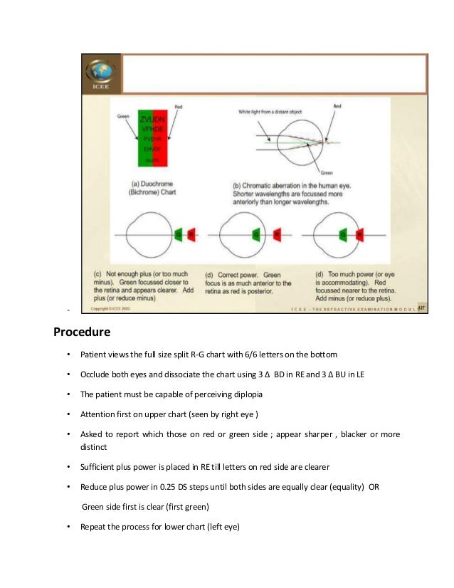 binocular balancing by optom faslu muhammed