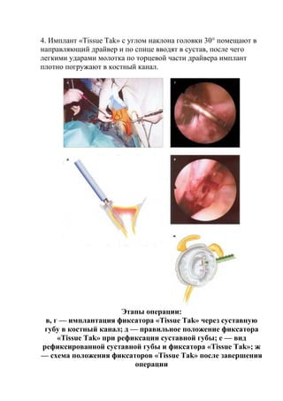4. Имплант «Tissue Таk» с углом наклона головки 30° помещают в
направляющий драйвер и по спице вводят в сустав, после чего
легкими ударами молотка по торцевой части драйвера имплант
плотно погружают в костный канал.
Этапы операции:
в, г — имплантация фиксатора «Tissue Таk» через суставную
губу в костный канал; д — правильное положение фиксатора
«Tissue Таk» при рефиксации суставной губы; е — вид
рефиксированной суставной губы и фиксатора «Tissue Таk»; ж
— схема положения фиксаторов «Tissue Таk» после завершения
операции
 