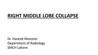 RIGHT MIDDLE LOBE COLLAPSE
Dr. Haseeb Manzoor
Department of Radiology
SMCH Lahore
 