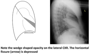Note the wedge shaped opacity on the lateral CXR. The horizontal
fissure (arrow) is depressed
 