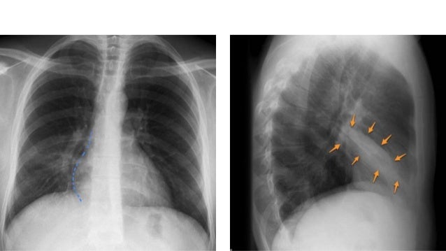 right middle lobe collapse right middle lobe collapse