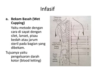 Infasif
a. Bekam Basah (Wet
Cupping)
Yaitu metode dengan
cara di sayat dengan
silet, lanset, pisau
bedah atau jarum
steril pada bagian yang
dibekam.
Tujuanya yaitu
pengeluaran darah
kotor (blood letting)
 