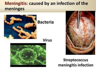 Meningitis: caused by an infection of the
meninges
Bacteria
Virus
Streptococcus
meningitis infection
 