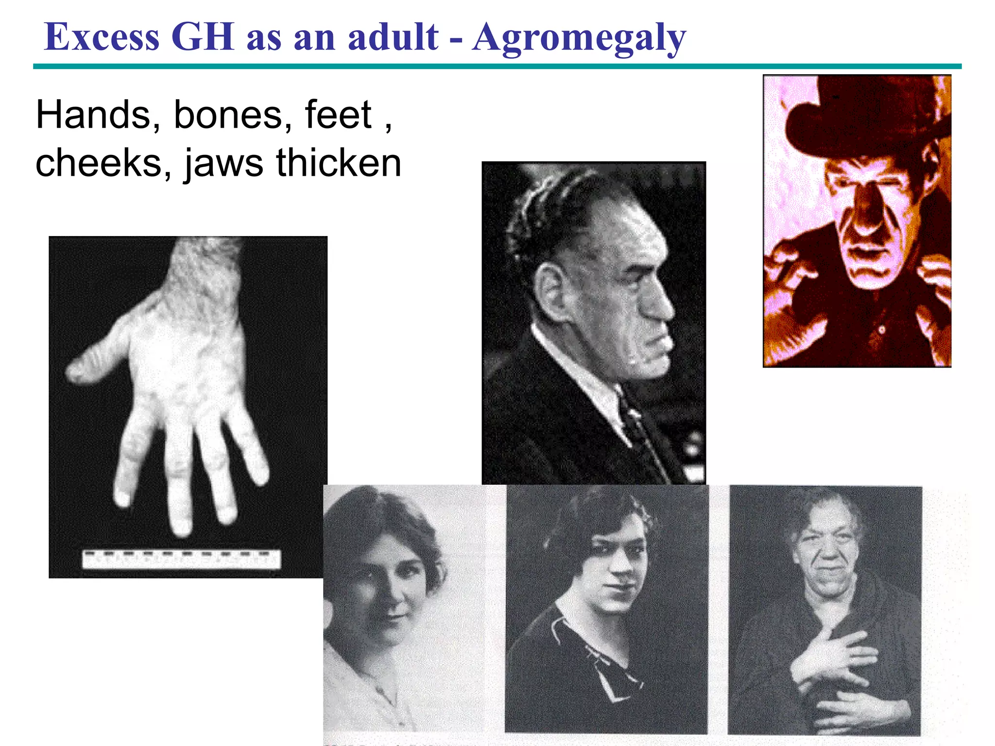Copyright © 2005 Pearson Education, Inc. publishing as Benjamin Cummings
Excess GH as an adult - Agromegaly
Hands, bones, feet ,
cheeks, jaws thicken
 