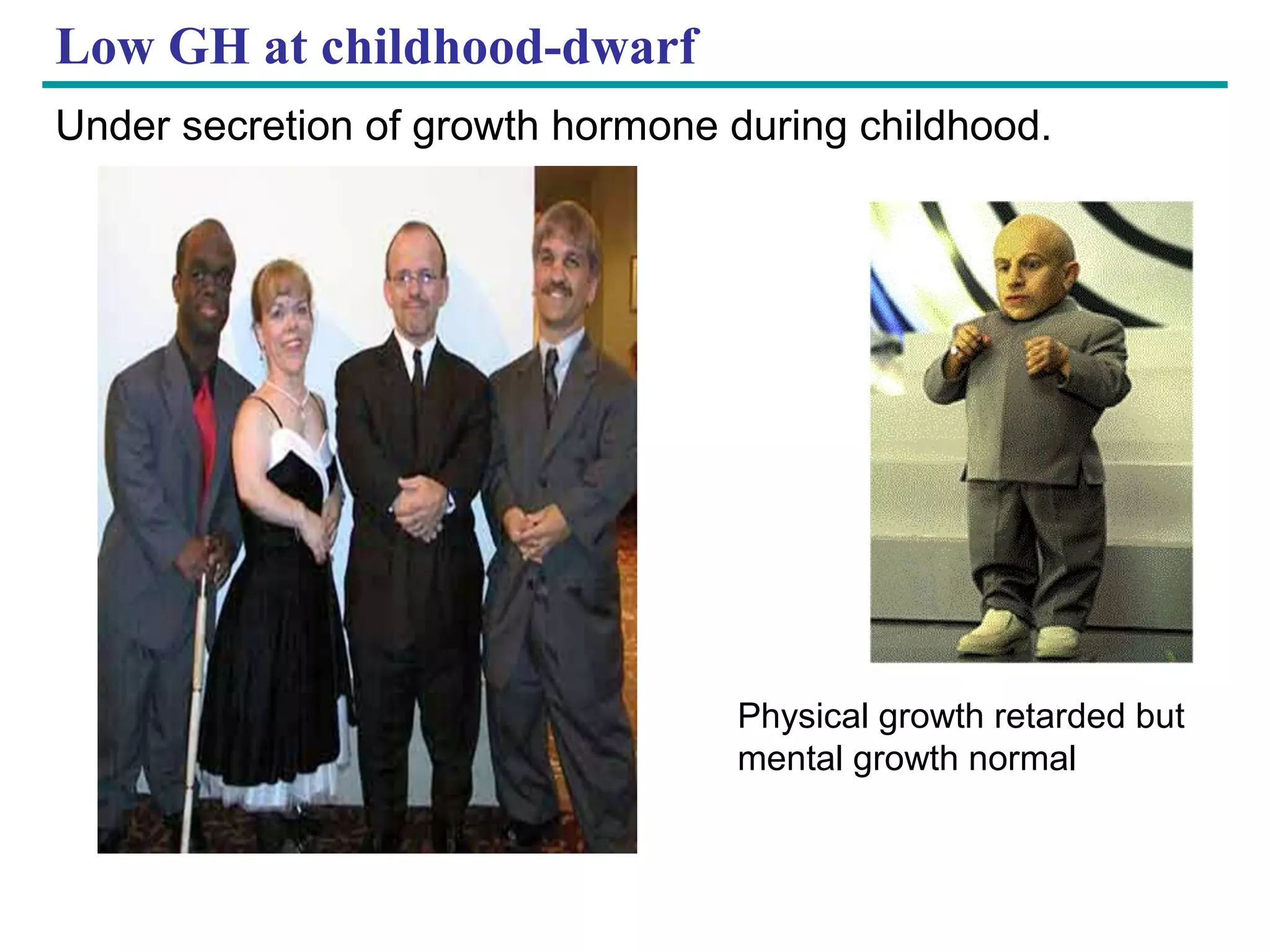 Copyright © 2005 Pearson Education, Inc. publishing as Benjamin Cummings
Low GH at childhood-dwarf
Under secretion of growth hormone during childhood.
Physical growth retarded but
mental growth normal
 