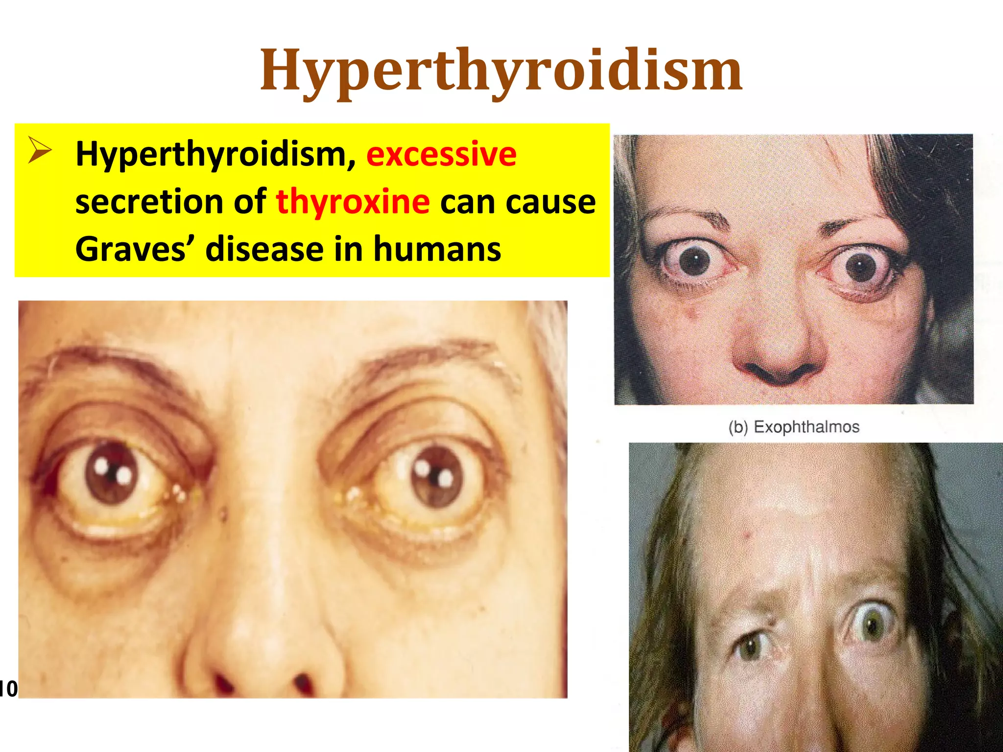  Hyperthyroidism, excessive
secretion of thyroxine can cause
Graves’ disease in humans
Hyperthyroidism
10
 