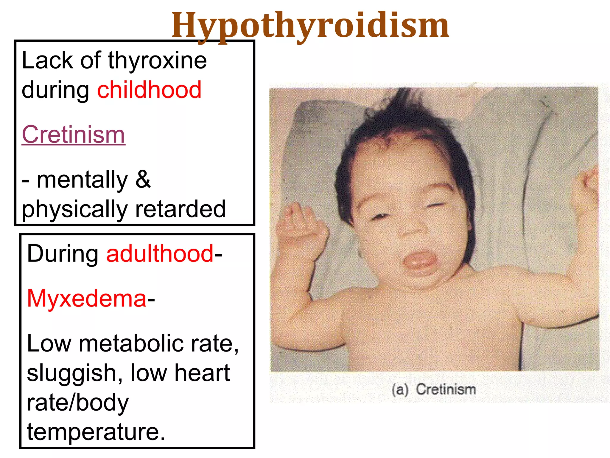 Lack of thyroxine
during childhood
Cretinism
- mentally &
physically retarded
Hypothyroidism
During adulthood-
Myxedema-
Low metabolic rate,
sluggish, low heart
rate/body
temperature.
 