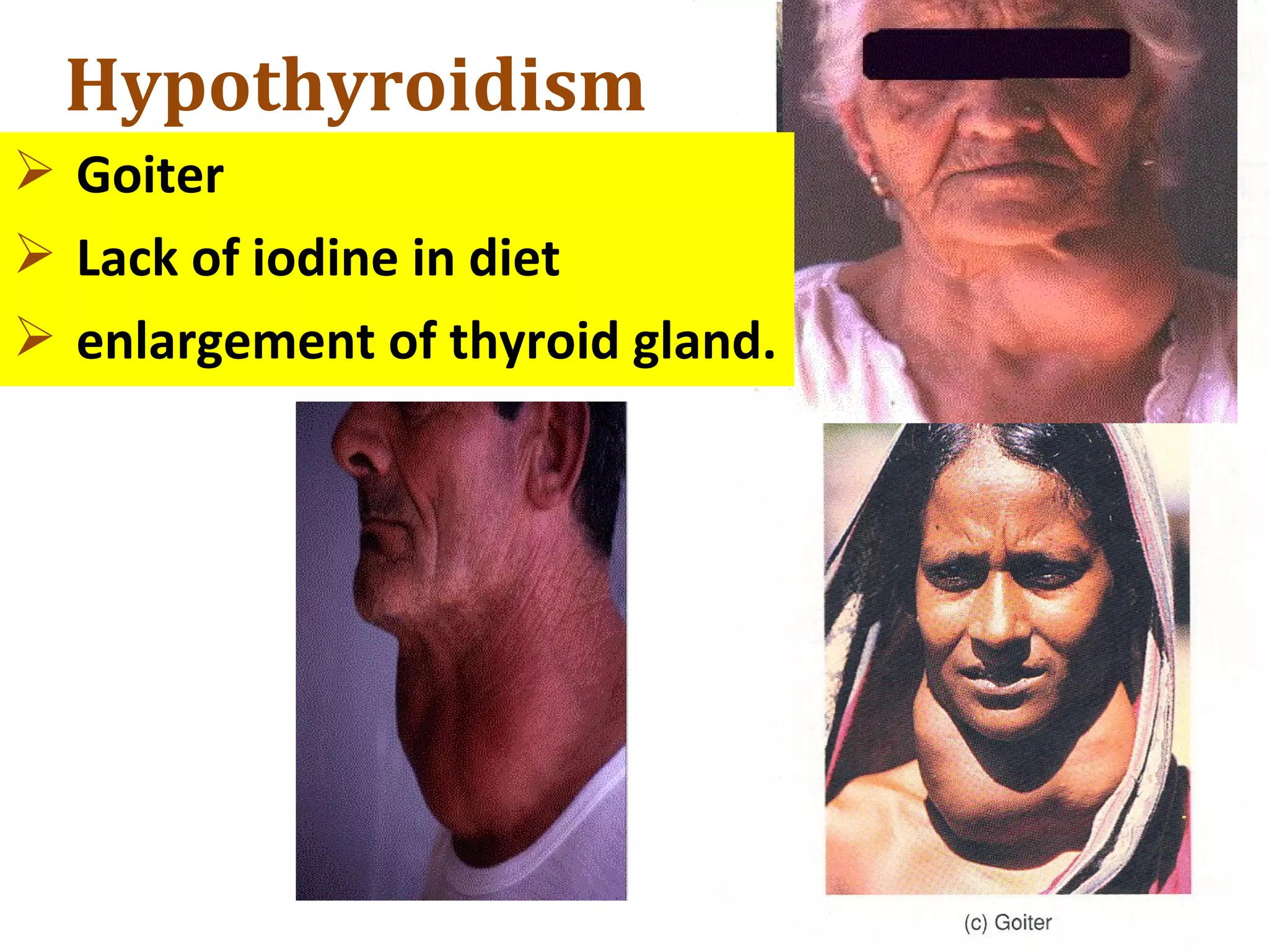 Hypothyroidism
 Goiter
 Lack of iodine in diet
 enlargement of thyroid gland.
 