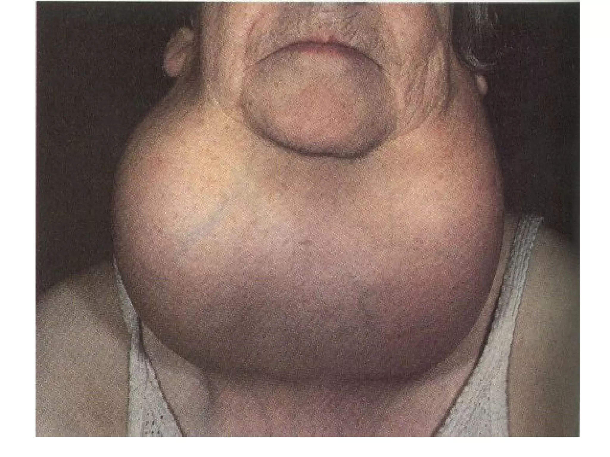 Goiter
 