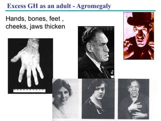 Copyright © 2005 Pearson Education, Inc. publishing as Benjamin Cummings
Excess GH as an adult - Agromegaly
Hands, bones, feet ,
cheeks, jaws thicken
 